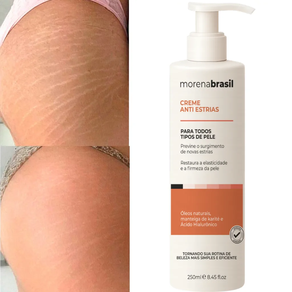 Creme AntiEstrias Removedor Estrias 200g Morena Brasil