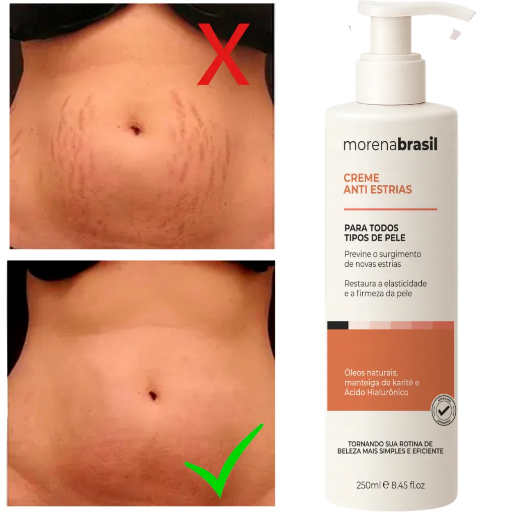 Creme Anti-Estrias
